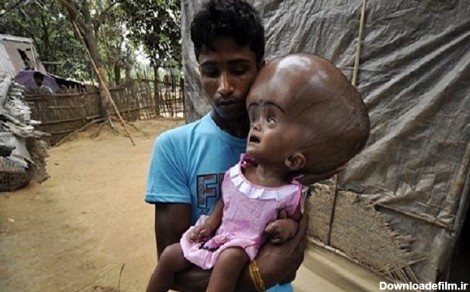 بیماری عجیب یک دختربچه هندی (+عکس)