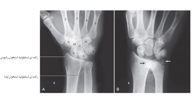 تکنیک های رادیوگرافی مچ دست (1)