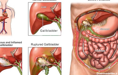 bursting of gall bladder به صورت طبیعی با سنگ کیسه صفرا مبارزه کنید
