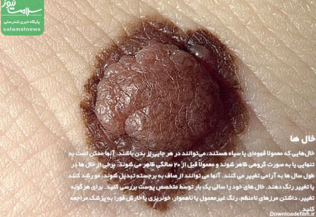 تصاویر انواع لکه های پوستی و روشهای درمان آنها - سلامت نیوز