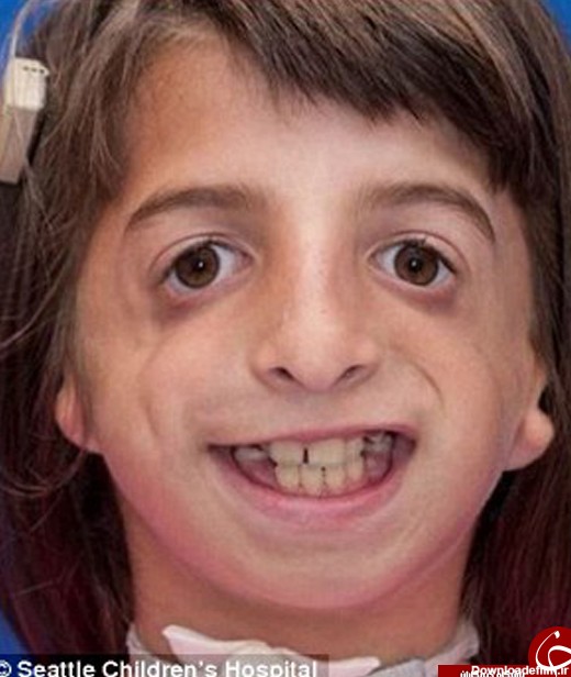 دختر 9 ساله بالاخره توانست بدون استفاده از لوله نفس بکشد +تصاویر