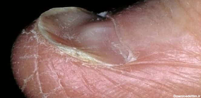 ناخن قاشقی (کویلونیشیا) از انواع بد شکلی ناخن پا