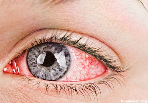 قرمزی چشم یا چشم خونی (Red Eye) و تحریک پذیری آن | دکتر مریم روشنی