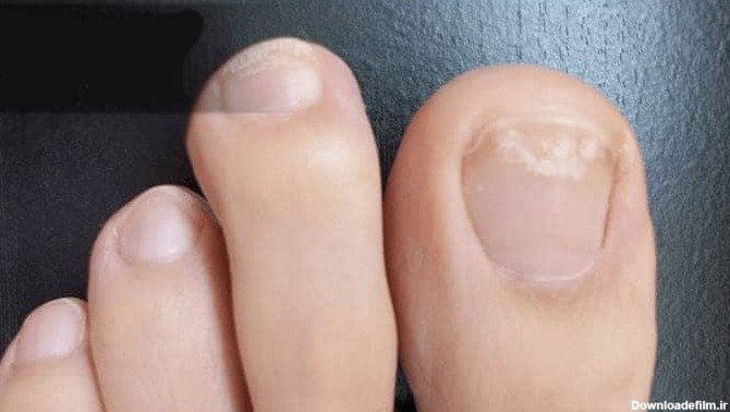 انواع بد شکلی ناخن پا: علت بدشکلی ناخن پا و روش درمان - کلینیک ...