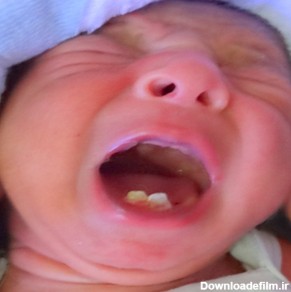 چرا برخی نوزادان با دندان متولد می شوند؟ دکتر یوسف رفیع جراح ...