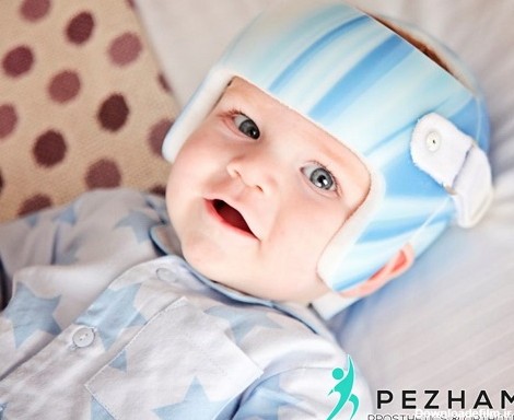 درمان بدشکلی های جمجمه نوزادان با کلاه اصلاحی