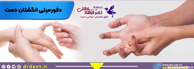 درمان دفورمیتی انگشتان دست در اصفهان، جراحی زیبایی انگشت دست ...