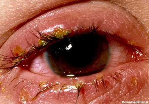 در این تصویر بیماری بلفاریت که یکی از دلایل قرمزی چشم است، مشاهده می‌شود.