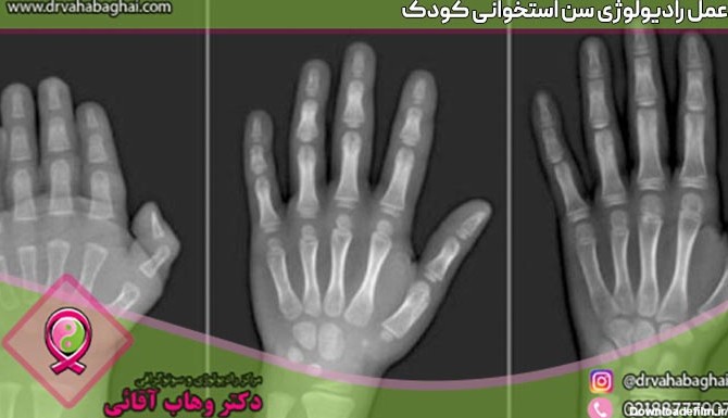 عکس رادیولوژی مچ دست کودک
