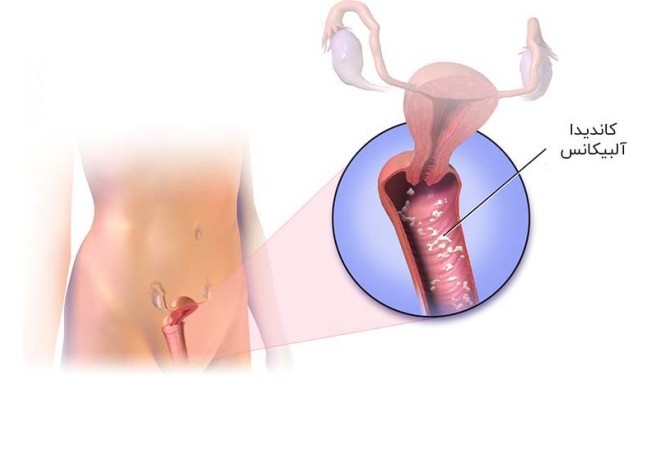 عفونت قارچی واژن چیست؟ علائم و روش درمان آن چیست؟ – مجله سلامت دکترتو