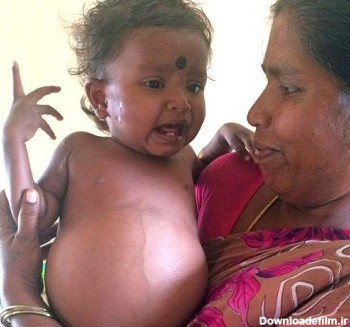 بیماری بسیار عجیب این دختر بچه هندی (عکس)