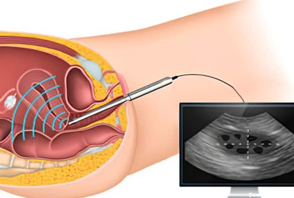 هیستروسونوگرافی چیست و چگونه انجام می شود؟ - مجتمع جامع پزشکی صدر