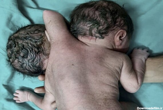 تصاویری از عجیب‌ترین نوزاد جهان در هند