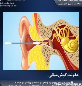عفونت گوش میانی | جراح و متخصص گوش و حلق و بینی | دکتر نسرین یزدانی