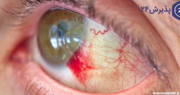 علت‌های خونریزی چشم و راه‌های درمان آن | پذیرش۲۴