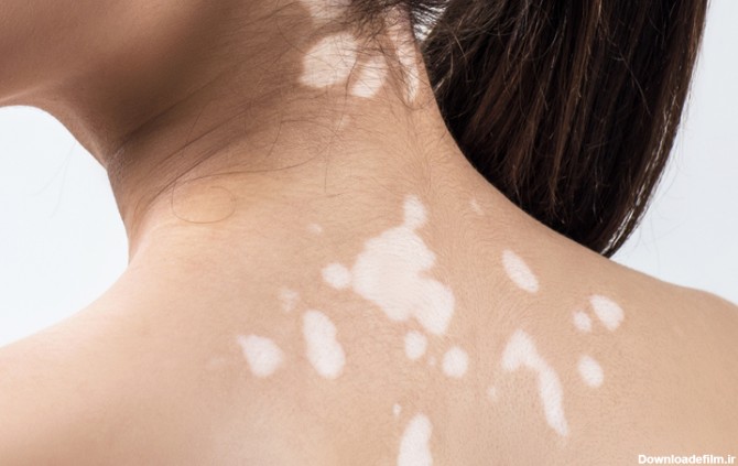 در بیماری ویتیلیگو، سلول‌های ایجاد کننده‌ی رنگ پوست از بین می‌روند. در نتیجه، لکه‌های سفید رنگ ظاهر می‌شوند