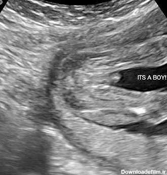 عکس جنین پسر در سونوگرافی و سونوگرافی تعیین جنسیت چگونه است | نی ...