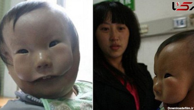 این کودک با یک نقاب بر صورت به دنیا آمد! +عکس