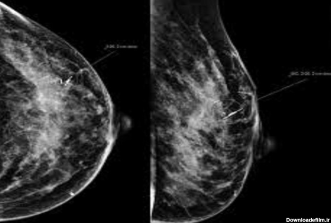 ماموگرافی هالوژیک - با ماموگرافی هالوژیک و دستگاه انجام دادن آن ...