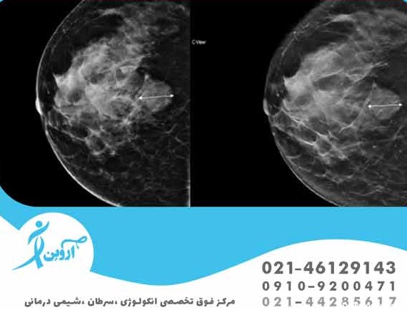 ماموگرافی مهمترین قدم برای غربالگری سینه - آروین کلینیک