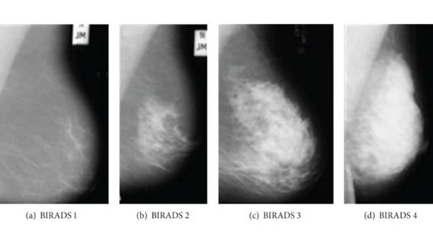 تشخیص بافت یا توده های سرطانی سینه با ماموگرافی - درمانکده