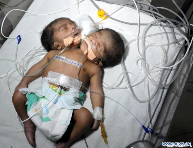 عکس/ تولد نوزاد دوسر در هند