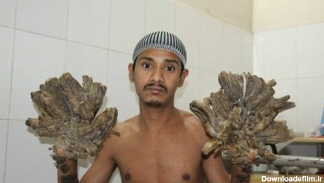 مرد درختی بنگلادشی جراحی شد (+ عکس)