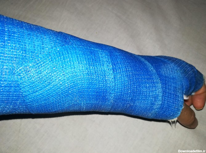 عکس پای شکسته گچ گرفته در بیمارستان