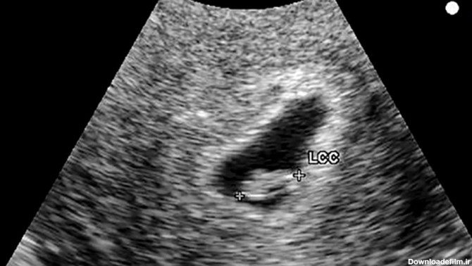 از چه زمانی بارداری در سونوگرافی معلوم میشود؟ + انواع روش تشخیص