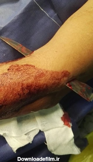 خروج چاقوی 10 سانتی از دست جوان 33 ساله+عکس | خبرگزاری فارس