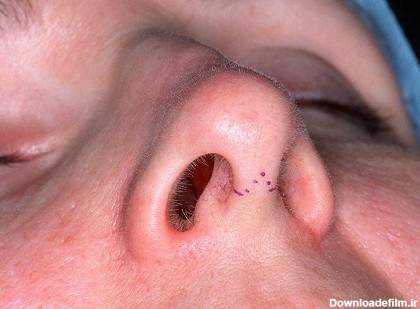 علت و درمان زخم های داخل بینی بعد ازعمل زیبایی رینوپلاستی