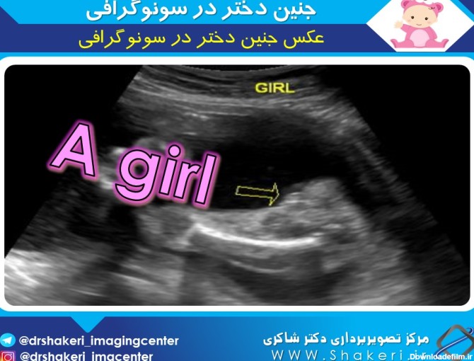 عکسهای سونوگرافی جنین دختر و پسر
