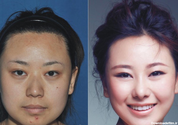 تصاویری از چهره زنان پس از عمل جراحی زیبایی - China Radio ...