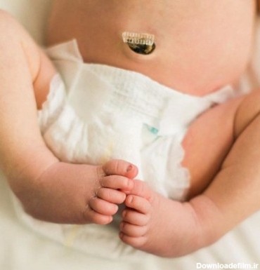 علائم و نشانه های عفونت کردن بند ناف نوزاد