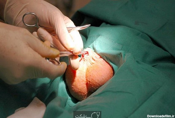 جراحی عقیم سازی مردان || پزشکت
