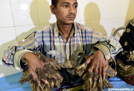 مرد درختی بنگلادش چطور عمل شد؟/امید به زندگی عادی پس از جراحی سخت