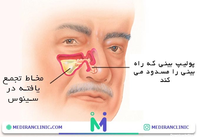 عکس پولیپ داخل بینی