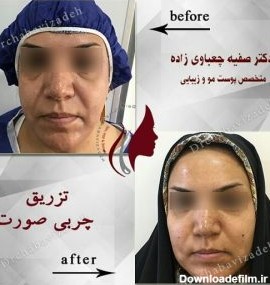 مزایا و معایب تزریق چربی به صورت | تزریق چربی به صورت در تهران ...