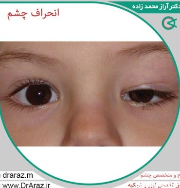 انحراف چشم | بهترین جراح و متخصص چشم تبریز | دکتر آراز محمدزاده