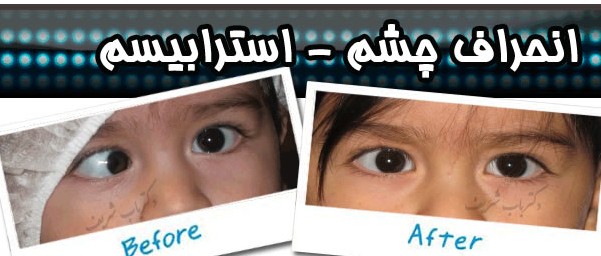 عکس‌های عمل انحراف چشم (استرابیسم) | دکتر بابک باب شریف