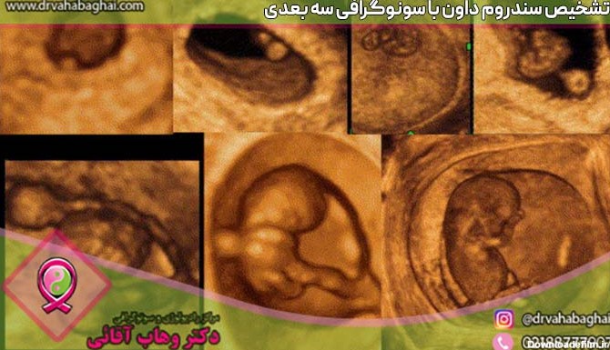 تشخیص سندروم داون در بارداری با سونوگرافی | مجموعه تصویربرداری ...