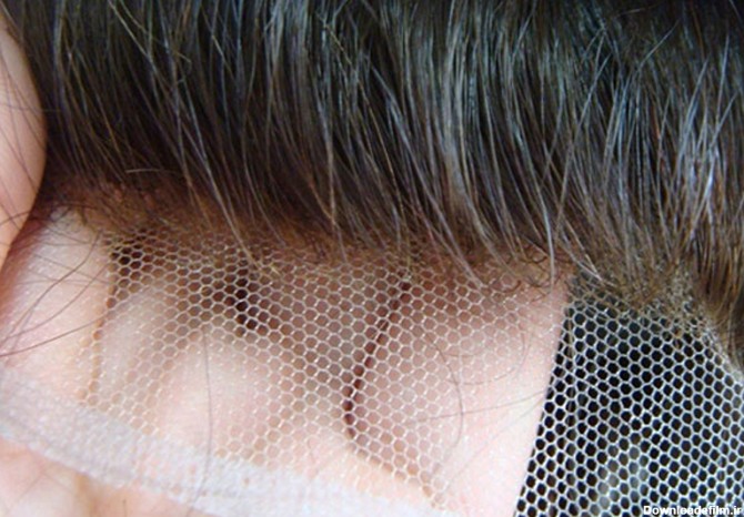 کاشت مو مصنوعی چیست و چگونه انجام می شود؟ | کلینیک صدف