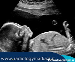 شناسایی سندروم داون در دوران جنینی