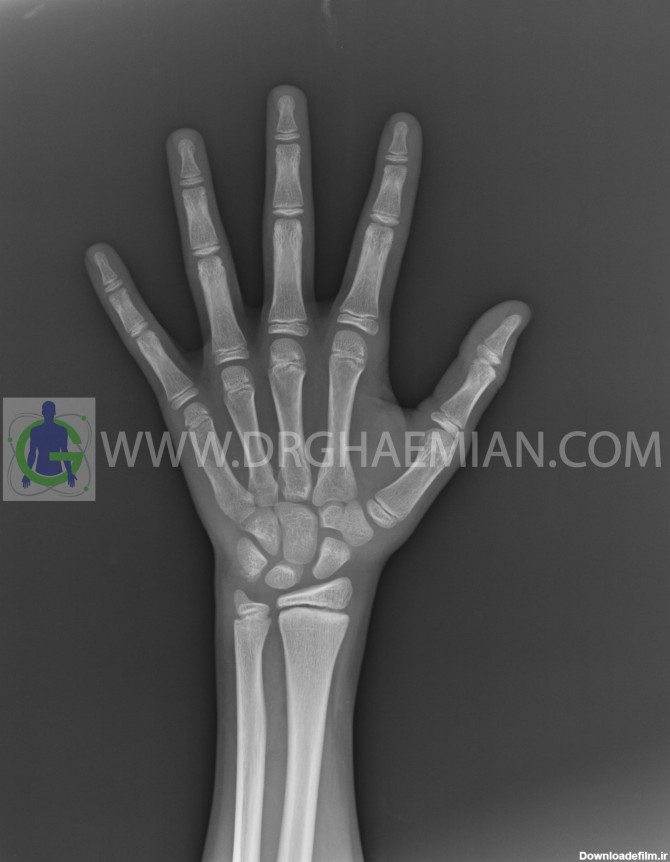 رادیولوژی دست - دکتر قائمیان | مرکز تصویر برداری پزشکی دکتر قائمیان