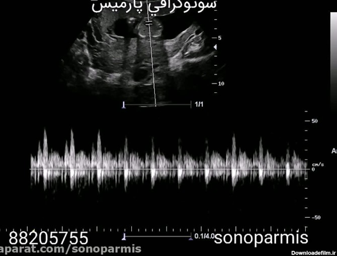 عکس ضربان قلب جنین