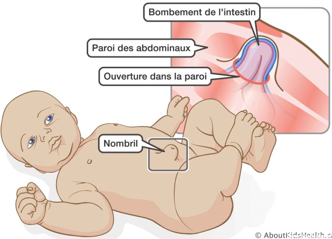 فتق ناف در نوزادان : علائم و عوارض فتق ناف در بارداری تا درمان آن ...