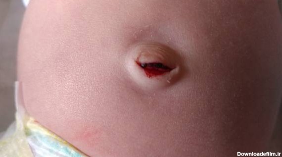 علل اصلی خونریزی ناف نوزاد + درمان و علائم خطر