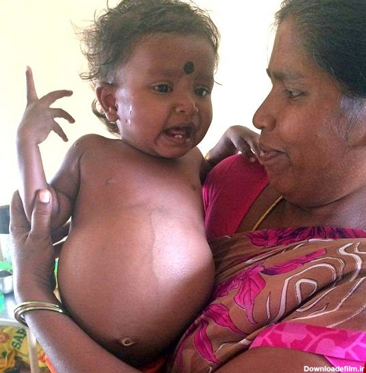 نوزاد دختر هنگام تولد، دوقلو باردار بود+تصاویر