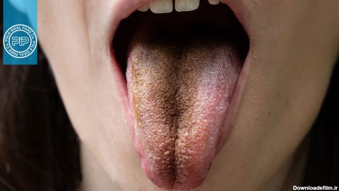 زبان سیاه مودار : علل ایجاد و نحوه درمان بیماری - مجله پل ایده‌آل پارس
