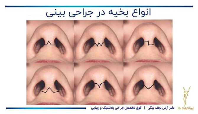 همه چیز در مورد جای بخیه‌ها بعد از عمل بینی |کلینیک جراحی دکتر آرش ...
